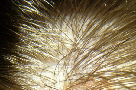 male scalp