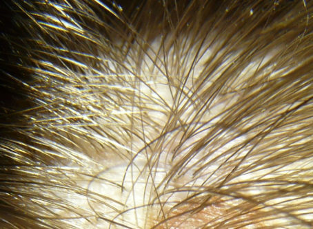 male scalp